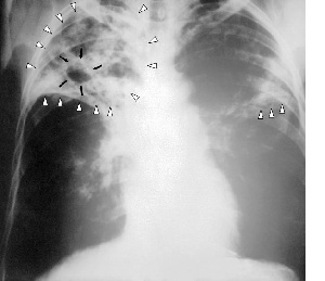 Tuberculosis X Ray 1gg