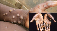 Monkey Pox yahatarisha maisha kwa baadhi ya mataifa barani Ulaya