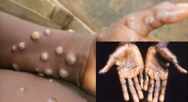 Monkey Pox yahatarisha maisha kwa baadhi ya mataifa barani Ulaya