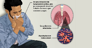 Tuberculosis Facebook Es 1200x630