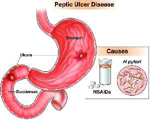 CGH Patient Ed Ulcer 2018 1024x824