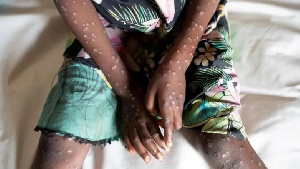 Aina Mpya Ya Ugonjwa Wa Monkey Pox Nchini DR Congo Ni 'hatari Zaidi'   Wataalamu